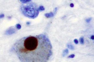Immunohistochemistry for alpha-synuclein showing positive staining (brown) of an intraneural Lewy-body in the Substantia nigra in Parkinson's disease.